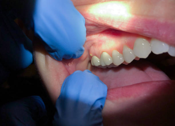 Best Broken Tooth Emergency  in Upper Sandusky, OH