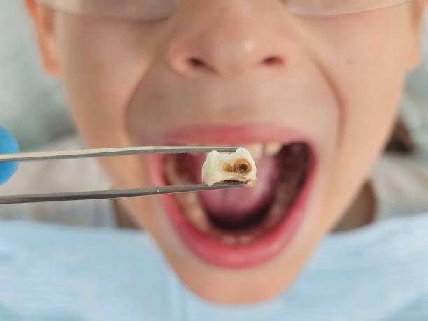 Best Tooth Infection Emergency Dentist  in Upper Sandusky, OH